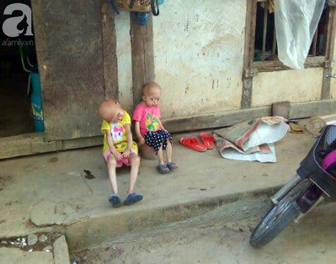 Tuyên Quang: 2 chị em gái mắc bệnh lạ khiến đầu, cổ bị nghẹo tựa người ngoài hành tinh khiến ai nhìn cũng xót xa - Ảnh 8. Tuyên Quang: 2 chị em gái mắc bệnh lạ khiến đầu, cổ bị nghẹo tựa 'người ngoài hành tinh' khiến ai nhìn cũng xót xa 7