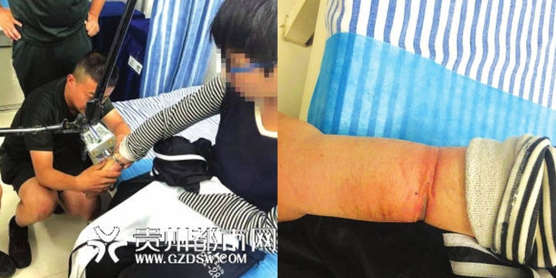 Tự đeo còng suốt 1 năm rồi mặc áo dài tay để giấu gia đình, cậu bé 14 tuổi bị chấn thương nghiêm trọng tới biến dạng cánh tay - Ảnh 1.