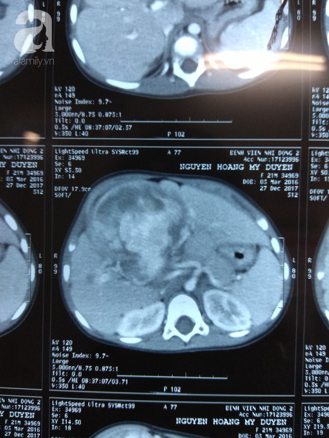 Bé gái 2 tuổi người Việt mang khối u ác tính ở gan cực hiếm gặp trên thế giới - Ảnh 1.