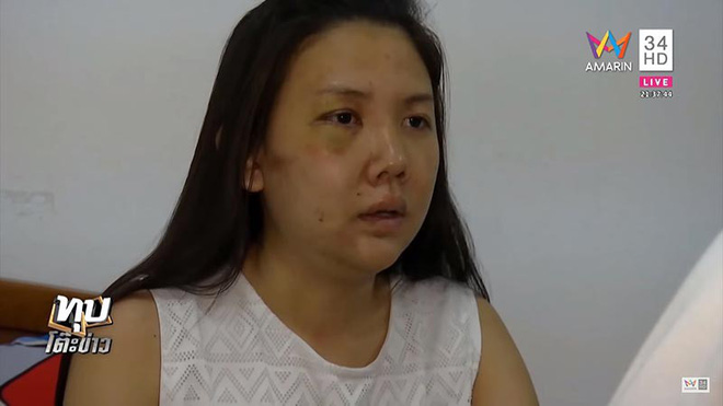 Cô gái bị người yêu đồng tính 7 năm đánh đập dã man lên tiếng: “Vết khâu vẫn còn đau, cơ thể đau, lòng cũng đau” - Ảnh 1. Cô gái bị người yêu đồng tính 7 năm đánh đập dã man lên tiếng: “Vết khâu vẫn còn đau, cơ thể đau, lòng cũng đau” 1