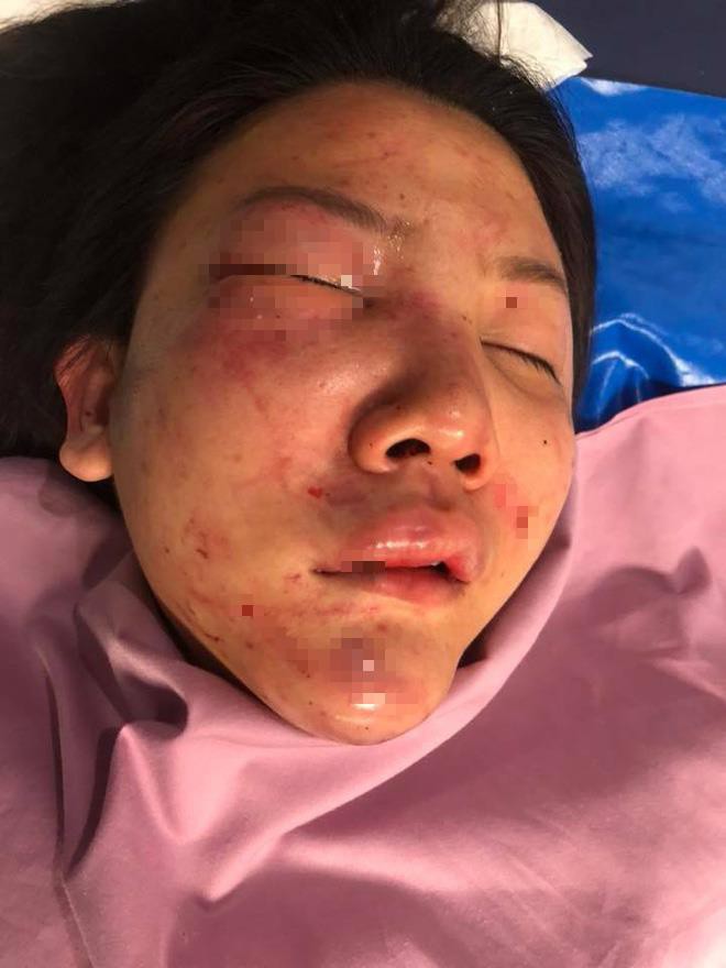 Cô gái bị người yêu đồng tính 7 năm đánh đập dã man lên tiếng: “Vết khâu vẫn còn đau, cơ thể đau, lòng cũng đau” - Ảnh 4. Cô gái bị người yêu đồng tính 7 năm đánh đập dã man lên tiếng: “Vết khâu vẫn còn đau, cơ thể đau, lòng cũng đau” 3