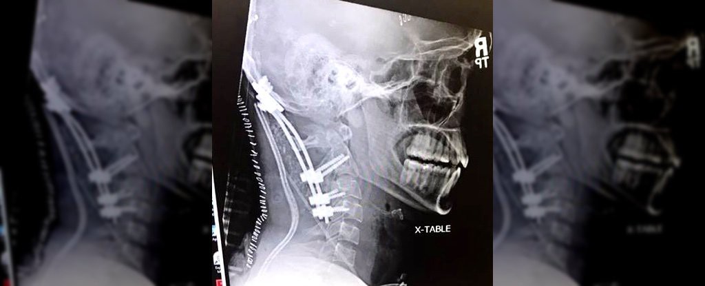 Chàng trai 22 tuổi gây chấn động y học vì sống sót sau tai nạn suýt rụng đầu - Ảnh 1. Chàng trai 22 tuổi gây chấn động y học vì sống sót sau tai nạn suýt rụng đầu - Ảnh 1.
