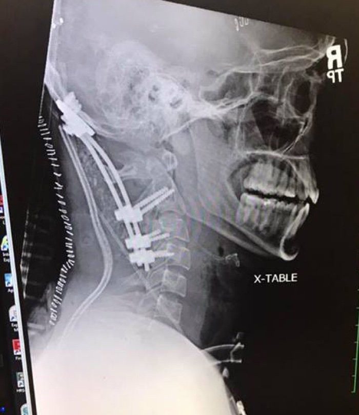 Chàng trai 22 tuổi gây chấn động y học vì sống sót sau tai nạn suýt rụng đầu - Ảnh 3. Chàng trai 22 tuổi gây chấn động y học vì sống sót sau tai nạn suýt rụng đầu - Ảnh 3.
