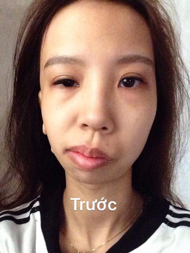 Bị bạn bè trêu chọc vì teo nửa bên mặt, cô gái Hà Nội lột xác sau phẫu thuật thẩm mỹ - Ảnh 2.