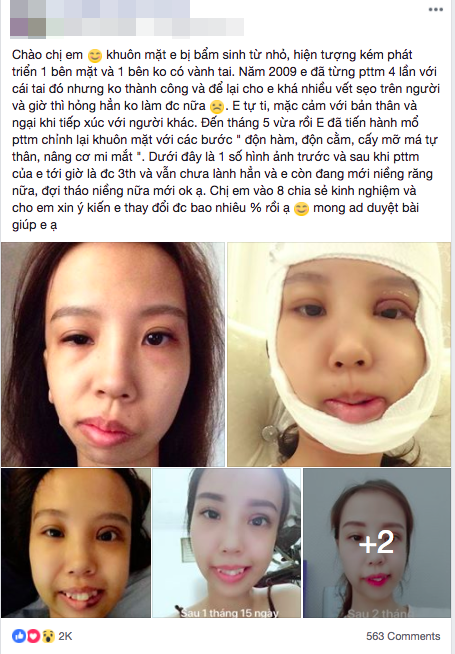 Bị bạn bè trêu chọc vì teo nửa bên mặt, cô gái Hà Nội lột xác sau phẫu thuật thẩm mỹ 1