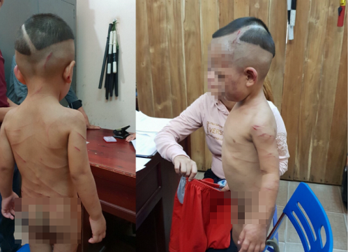 Đã có kết luận vụ cha dượng đánh dã man bé 3 tuổi ở Phú Quốc 2