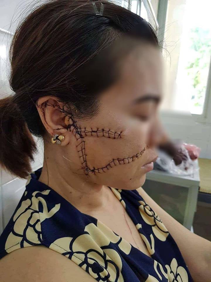 Người chồng rạch mặt, cắt gân vợ lý giải vì... quá yêu: Tôi gây ra chuyện vì biết cô ấy về làm thủ tục kết hôn với người nước ngoài - Ảnh 1. Người chồng rạch mặt vợ lý giải vì... quá yêu: 'Tôi gây ra chuyện vì biết cô ấy về làm thủ tục kết hôn với người nước ngoài' 1