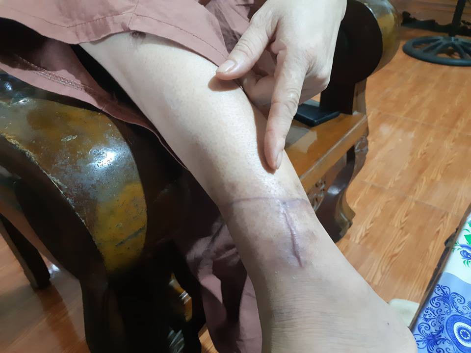 Người chồng rạch mặt, cắt gân vợ lý giải vì... quá yêu: Tôi gây ra chuyện vì biết cô ấy về làm thủ tục kết hôn với người nước ngoài - Ảnh 3. Người chồng rạch mặt vợ lý giải vì... quá yêu: 'Tôi gây ra chuyện vì biết cô ấy về làm thủ tục kết hôn với người nước ngoài' 3