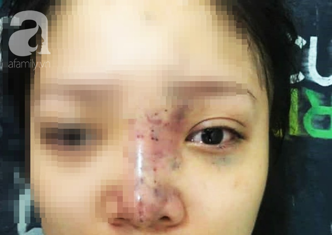 Tiêm filler nâng mũi, nữ sinh viên 20 tuổi ở Sài Gòn đối diện nguy cơ hoại tử da, mù mắt vĩnh viễn 2
