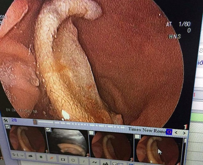 Công an vào cuộc vụ nam sinh cắn đứt tai bạn rồi nuốt luôn vào bụng 2 Công an vào cuộc vụ nam sinh cắn đứt tai bạn rồi nuốt luôn vào bụng 2