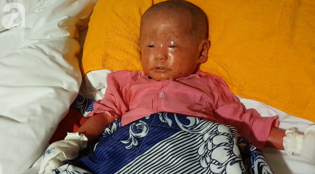 Hình ảnh mới nhất của bé Bích bị bỏ rơi, người đầy vẩy ngứa như da trăn sau đợt khám bệnh đầu tiên tại Singapore - Ảnh 3.