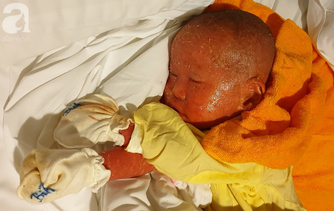 Hình ảnh mới nhất của bé Bích bị bỏ rơi, người đầy vẩy ngứa như da trăn sau đợt khám bệnh đầu tiên tại Singapore - Ảnh 6.