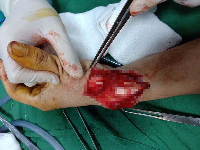 Vụ tài xế ô tô bị chặt tay: Người đi xe máy dựng xe chặn đầu rồi gọi người đến đánh - Ảnh 2. Vụ tài xế ô tô bị chặt tay: 'Người đi xe máy dựng xe chặn đầu rồi gọi người đến đánh' 3