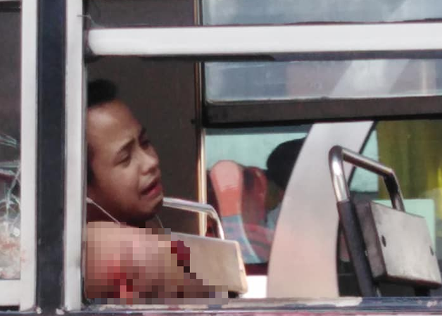 Nam thanh niên mất cánh tay sau một giấc ngủ trên xe buýt vì lý do rùng mình 1