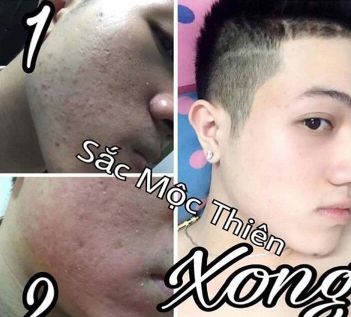 Trị hết mụn trong 2 tuần với SẮC MỘC THIÊN - ảnh 1 Hình ảnh Trị hết mụn trong 2 tuần với SẮC MỘC THIÊN số 1
