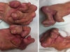 Cận cảnh đôi bàn tay bị biến dạng kinh hoàng do không điều trị viêm khớp
