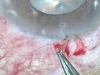 Giun đũa chó kí sinh trong mắt bệnh nhân ở Nghệ An
