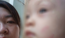 Hà Nội: Bé 20 tháng tuổi nghi bị cắn bầm tím người khi đi học
