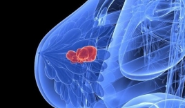 Nguyên PGĐ Bệnh viện K chỉ rõ 4 nguyên nhân gây 80\% trường hợp ung thư vú