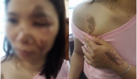 Hà Nội: Nữ chủ tiệm thuốc tố bị bác sỹ tạt axit đến bỏng nặng khi gạ gẫm không thành