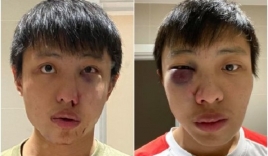 Một sinh viên Singapore ở Anh bị đánh bầm dập, gọi là 'corona'  