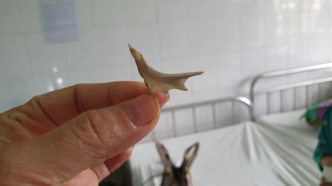 Đồng Nai: Bé trai hóc xương cá hình chân vịt trong thực quản