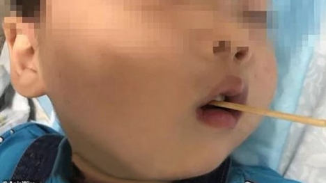 Hy hữu: Bé trai 3 tuổi sống sót thần kỳ sau khi bị xiên xúc xích đâm xuyên não
