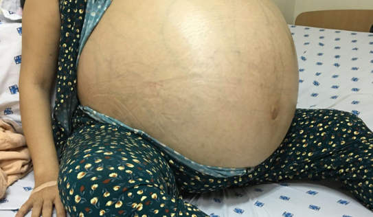 6 giờ ròng rã cứu mạng người phụ nữ mang khối u buồng trứng lớn nhất Việt Nam