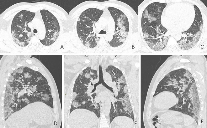 3 dấu hiệu cho thấy phổi bệnh nhân mắc Covid-19 bị tổn thương 1