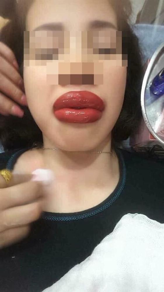 Đầu tư 2 triệu xăm môi đón Tết, cô gái phải đến bệnh viện cầu cứu bác sĩ 2 Đầu tư 2 triệu xăm môi đón Tết, cô gái phải đến bệnh viện cầu cứu bác sĩ 2