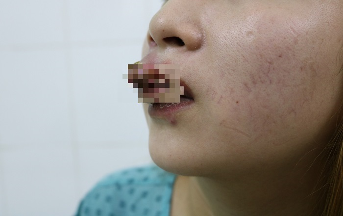 Đầu tư 2 triệu xăm môi đón Tết, cô gái phải đến bệnh viện cầu cứu bác sĩ 1 Đầu tư 2 triệu xăm môi đón Tết, cô gái phải đến bệnh viện cầu cứu bác sĩ 1