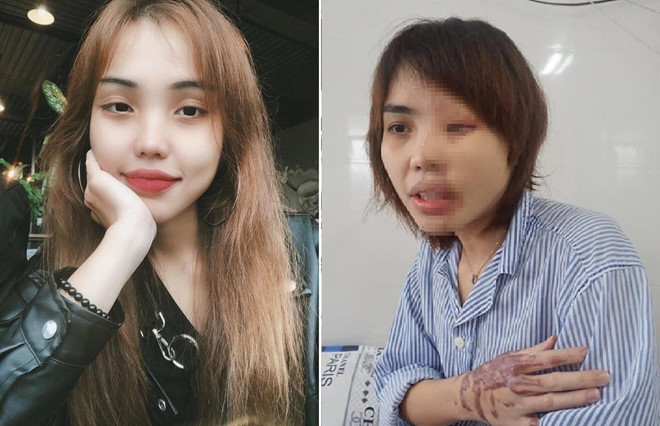 Cô gái bị chồng sắp cưới huỷ hoại gương mặt tái xuất với tạo hình đậm chất nghệ thuật 1 Cô gái bị chồng sắp cưới huỷ hoại gương mặt tái xuất với tạo hình đậm chất nghệ thuật 1