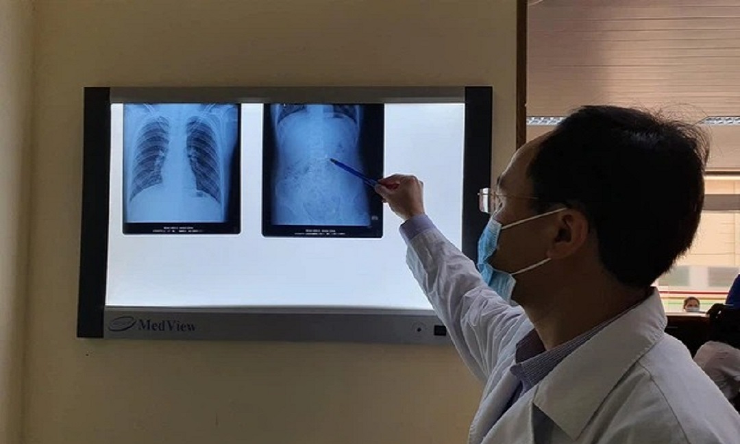 Kết quả chụp X-quang cho thấy, trong ổ bụng bệnh nhi có hình tai nghe điện thoại không dây. Ảnh: BSCC