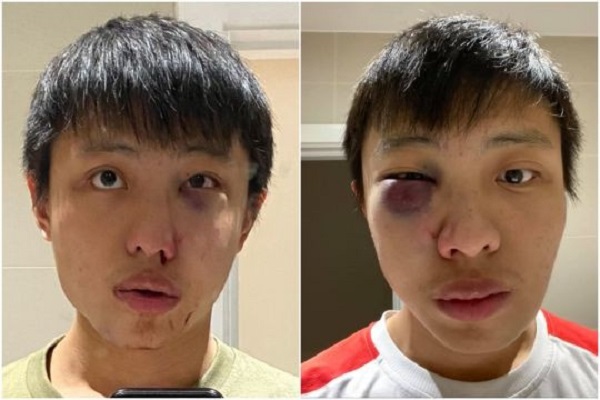 Một sinh viên Singapore ở Anh bị đánh bầm dập, gọi là 'corona'   1