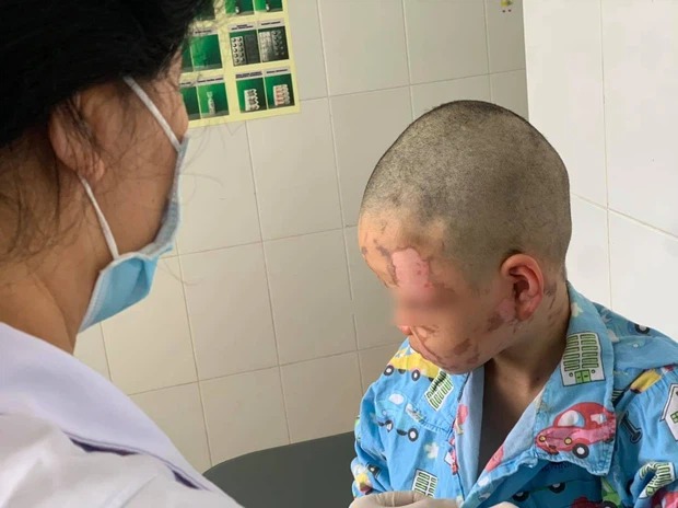Bé trai 10 tuổi bỏng nặng do cồn sau khi học theo clip trên mạng 2 Bé trai 10 tuổi bỏng nặng do cồn sau khi học theo clip trên mạng 2