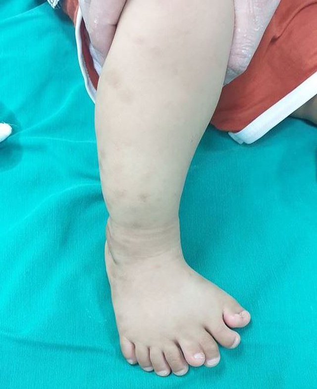 Kỳ lạ cậu bé 11 tháng tuổi ở Thanh Hóa có đến 9 ngón trên 1 bàn chân 1