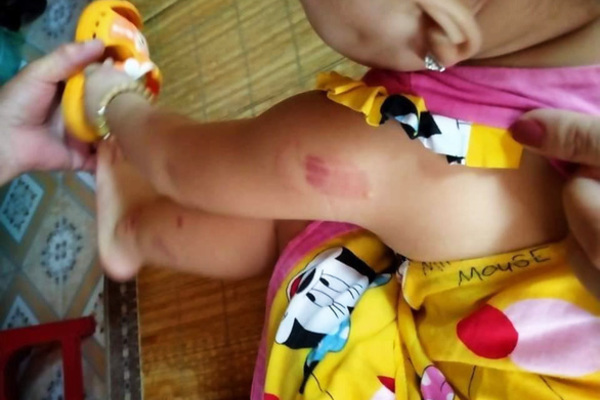 Bé gái 21 tháng tuổi ở Thái Bình bị cắn 12 vết tím người sau khi đi học buổi thứ 2 3
