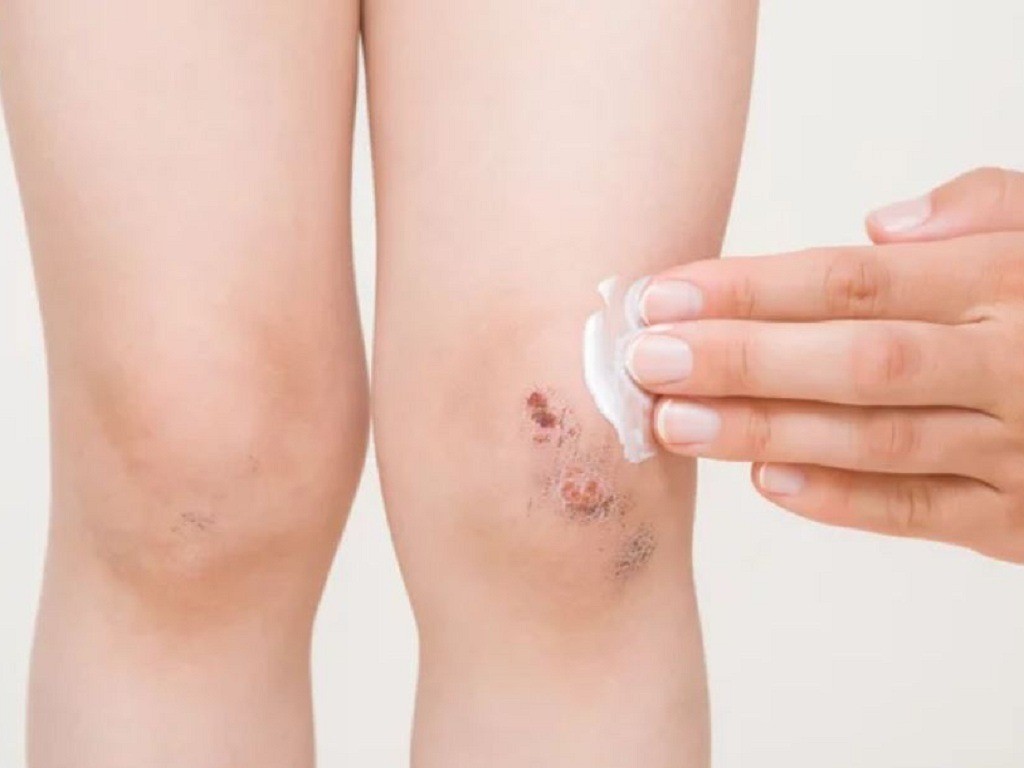 Vết thương nhanh lành là biểu hiện của người có hệ thống miễn dịch khỏe. Ảnh minh họa: Internet Vết thương nhanh lành là biểu hiện của người có hệ thống miễn dịch khỏe. Ảnh minh họa: Internet