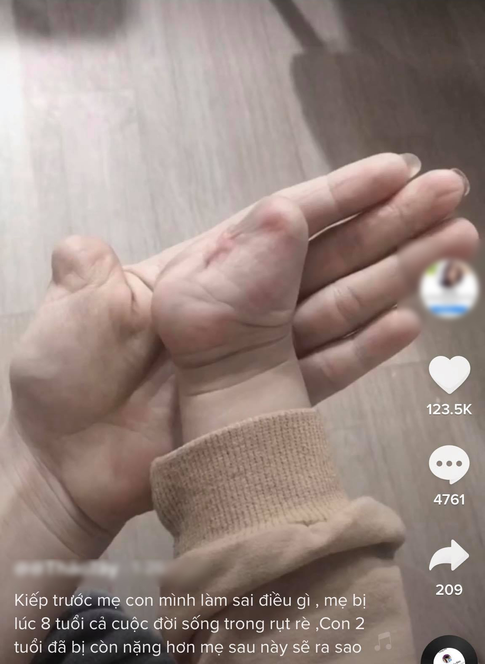 Hình ảnh cặp mẹ con đều bị mất một tay vì tai nạn khiến nhiều người xót xa 1 Hình ảnh cặp mẹ con đều bị mất một tay vì tai nạn khiến nhiều người xót xa 1