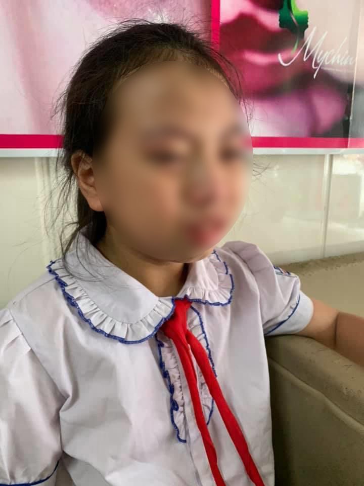 Bé gái lớp 4 giàn giụa nước mắt vì bị cô giáo ở Hà Giang tát đỏ mặt ngay trong buổi học đầu tiên  3