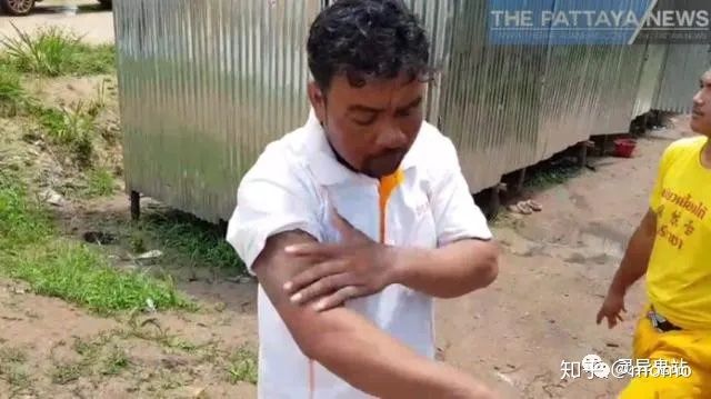 Sống sót thần kỳ sau khi bị 'Thiên Lôi' hỏi thăm, người đàn ông chợt nhận ra 'giới tính thật' 3 Sống sót thần kỳ sau khi bị 'Thiên Lôi' hỏi thăm, người đàn ông chợt nhận ra 'giới tính thật' 3
