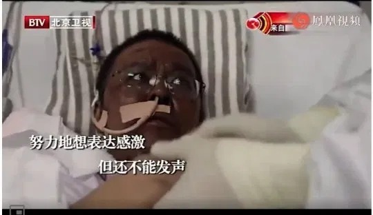 Bác sĩ nhiễm Covid-19 tại Vũ Hán đổi màu da sau khi điều trị 3
