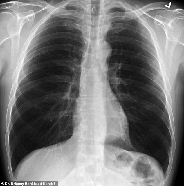Phim X-quang lá phổi hậu Covid-19 khiến bác sĩ choáng váng 2