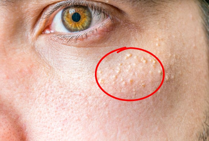 Môi mỏng, bọng mắt và loạt dấu hiệu cảnh báo mặt bạn đang lão hóa sớm 1 Môi mỏng, bọng mắt và loạt dấu hiệu cảnh báo mặt bạn đang lão hóa sớm 1