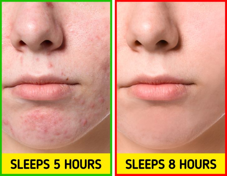 7 thứ gây mụn mà bạn không ngờ đến: Để chó liếm mặt và hôn hít đứng đầu danh sách 5 7 thứ gây mụn mà bạn không ngờ đến: Để chó liếm mặt và hôn hít đứng đầu danh sách 5